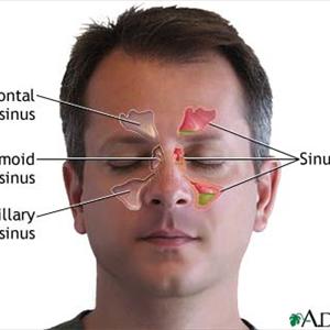 Blocked Sphenoid Sinus - Headache: Affects The Mental Health Of A Person