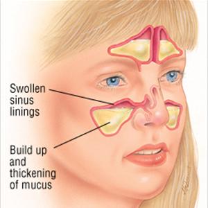 Sinus Cysts Diagnosis - Say Goodbye To Sinus Headaches