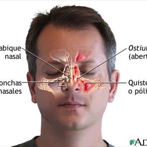 Swollen Sinuses Causes - How To Use A Neti Pot In Three Simple Steps