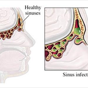 Sphenoid Sinus Blockage - Preventing Sinusitis Surgery