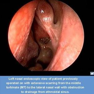 Paranasal Sinuses Anatomy - Various Causes And Possible Treatment Of Sinus Infection