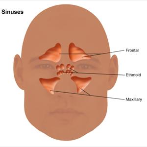 Acute Sinusitis Pathology - Sinus Infection In Children