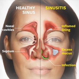 Fungal Sinusitis Natural - Natural Treatment For Sinus Infections
