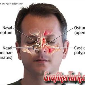 Allergies And Sinus Relief - Treat Your Sinusitis Right