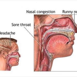 Spenoid Sinusitis - How To Relieve Sinus Pressure