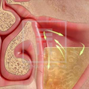 Ent Sinusitis Guidelines - Important Facts About Sinus Infections