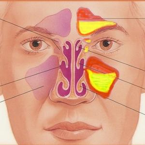 Clear The Sinuses - Natural Remedies For Sinus Headaches