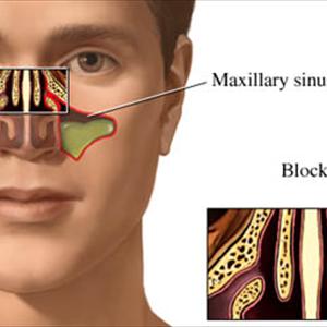 Acute Bacterial Sinusitis Patients - Sinusitis What Is It? Information On Sinusitis & Some Natural Remedies