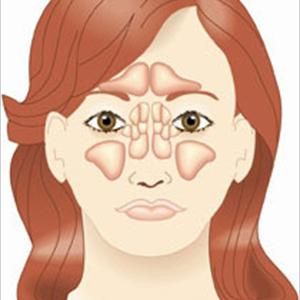 Acute Sinuses - Sinusitis Treatment May Or May Not Include Antibiotics