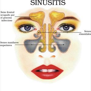Sinusitis Signs And - The Problems That May Occur With Sinusitis