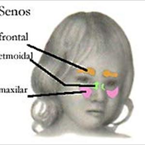 Sphenoid Sinus - How Do I Get Rid Of Sinus Headache?
